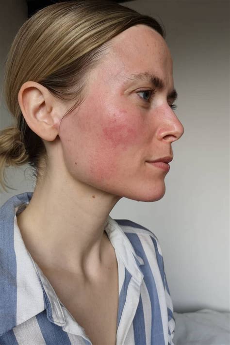 Sensitive Skin What It Looks Like What Can Cause It And What You Can
