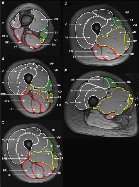 The thigh muscles are divided into three compartments: Illustration of segmented MRI ACSAs of the thigh at a 20 % ...