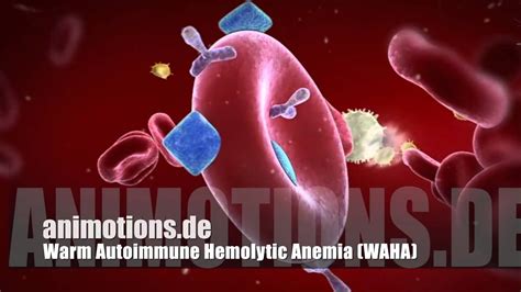WAHA Warm Autoimmune Hemolytic Anemia AIHA - YouTube
