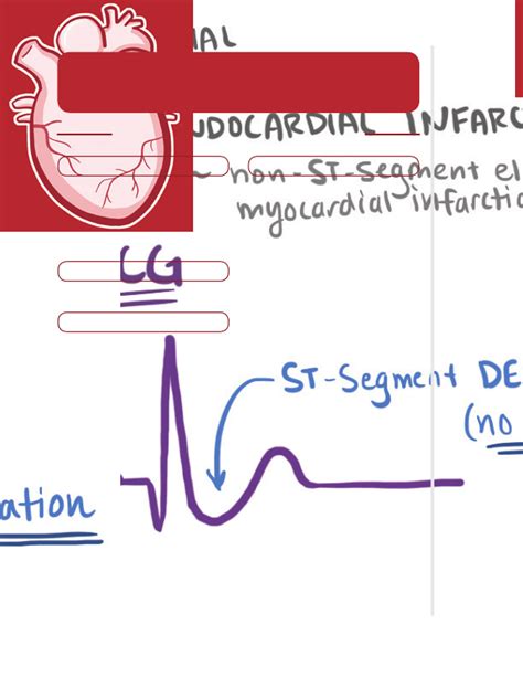 Acute Coronary Syndromes Notes Diagrams And Illustrations Osmosis