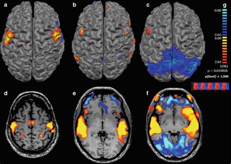 Use Of Fmri Activation Paradigms A Presurgical Tool For Mapping Brain