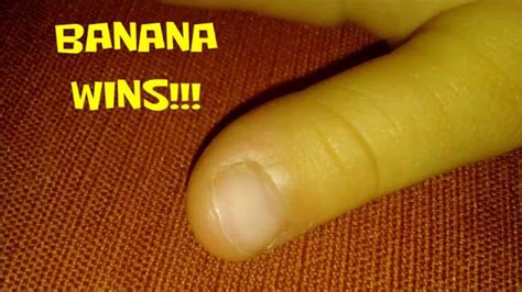 How To Remove A Finger Wart With A Banana Peel Home Remedy Youtube