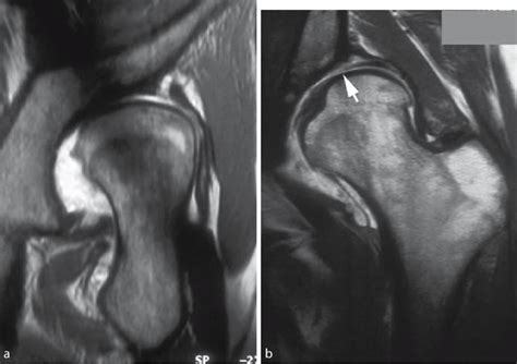 A Magnetic Resonance Imaging Mri Shows An Avulsion Of The Labrum From