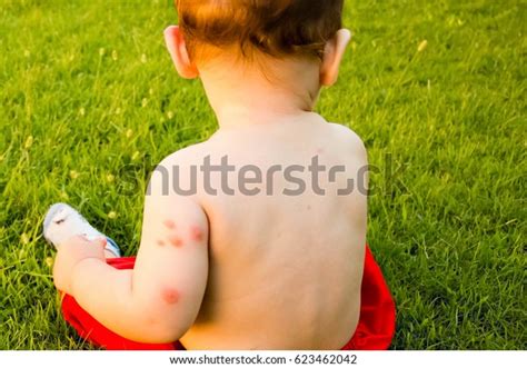 New Born Multiple Mosquito Bites Allergy Stock Photo 623462042