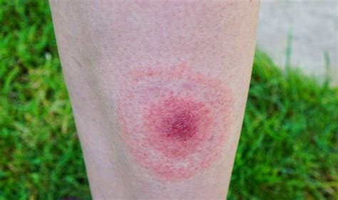 lyme disease symptoms four early signs of being bitten by an infected tick health news 2 me