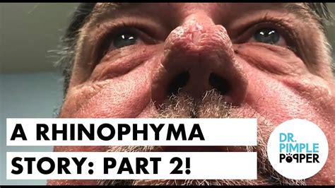 A Rhinophyma Story Part 2 Youtube