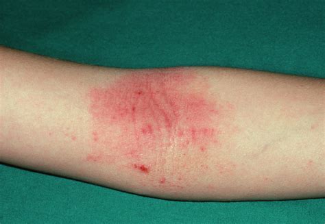 Atopic Eczema On The Inside Of The Elbow Photograph By Dr P Marazzi Science Photo Library