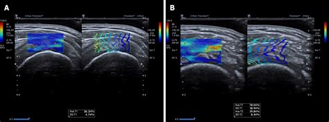 Role Of Shear Wave Elastography In The Evaluation Of The Treatment And
