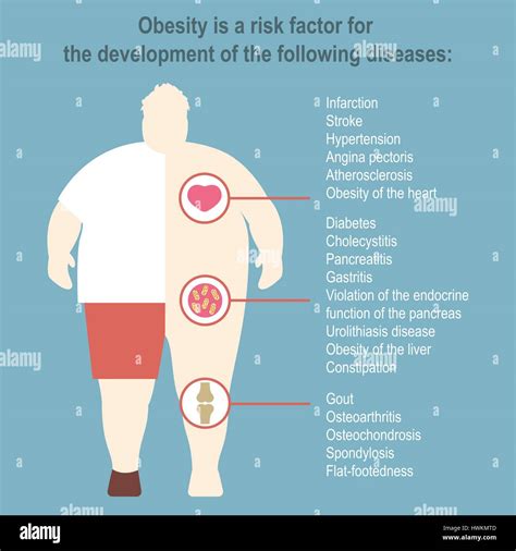 Obesity Vector Illustration Poster Template The Effect Of Obesity On