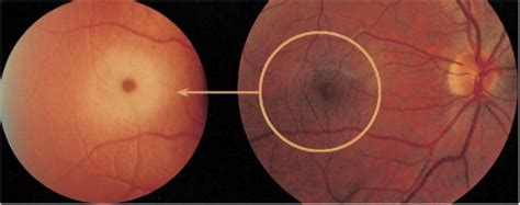 15.58) is a clinical sign seen in the context of thickening and loss of transparency of the retina at the posterior pole. Cherry-red spot in Tay-Sachs disease. The right frame ...
