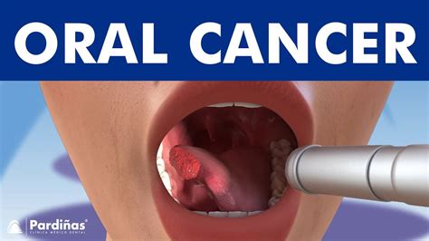 ORAL CANCER And Tumors In The Mouth Lips And Tongue YouTube