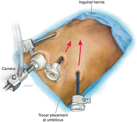 Minimally Invasive Surgical Techniques For Inguinal Hernia Repair The