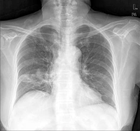 A Chest Radiograph Revealed An Ill Defined Consolidation In The Right