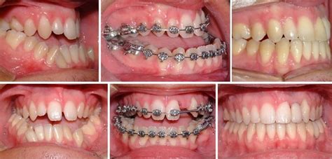 ¿cuánto Dura Un Tratamiento De Ortodoncia Solución Dental