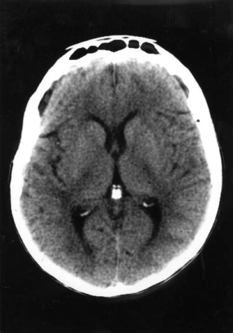 Intracerebral Haemorrhage Due To Possible Venous Obstruction In The