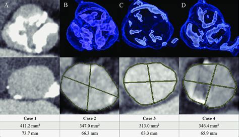 Figure1distribution Of Annulus Calcification Aortic Annulus Area And