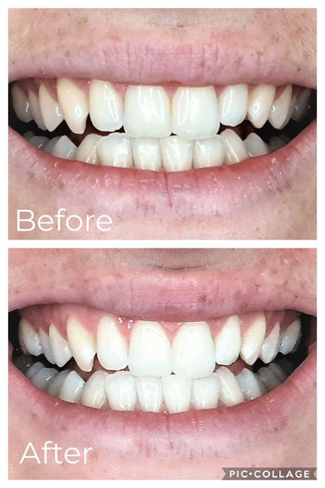 Testimonials Professional Teeth Whitening Sparkle White Teeth