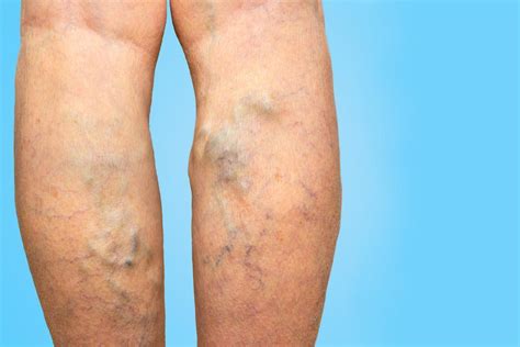Your Varicose Veins May Be More Than Just A Cosmetic Concern Kunal