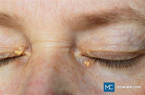 Yellow Patches On Your Eyelids Is It Xanthelasma Mya Care