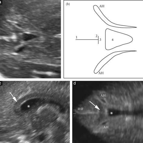 Ultrasound Image A And Diagram B Of An Abnormal Anterior Complex In