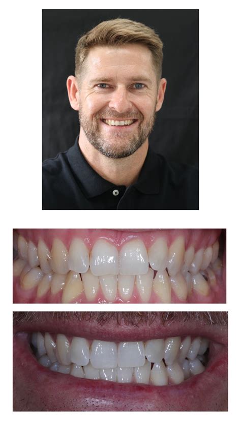 Zoom Teeth Whitening Brisbane Brisbane Smile Boutique Dentists