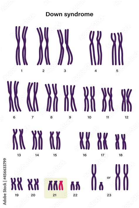 Human Karyotype Of Down Syndrome Autosomal Abnormalities Down
