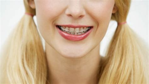 Common Braces Problems To Watch For Blog