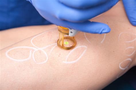 Laser hair removal works by using wavelengths of light to destroy melanin. Nose Vein Removal - MySkin Clinics
