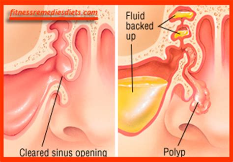 Nasal polyp treatment usually starts with drugs, which can make even large polyps shrink or disappear. Polyps in Nose. Nasal Polyps Treatment - Effective Methods ...