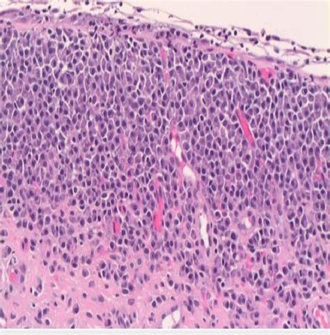 Histopathology Showing Finding Suggestive Of Malt Lymphoma With