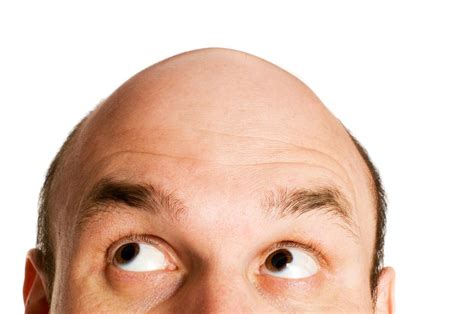 Understanding Your Risks Can Slow Male Pattern Baldness Longevity Live