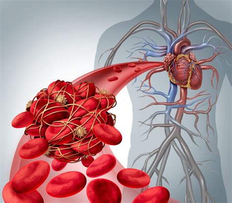 Blood Clots Deep Vein Thrombosis Dvt And Pulmonary Embolism Pe