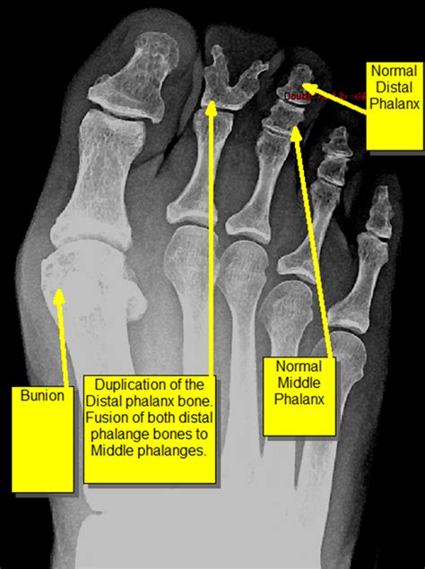 Congenital Duplication Of Digit Webbed Toes Six Toes Or Four Toes