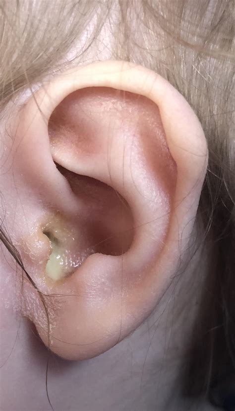 My toddler’s ear (already been to urgent care and got treatment) : r