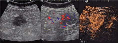 A Abdominal Ultrasonography Of The Left Hypochondrium Showing A
