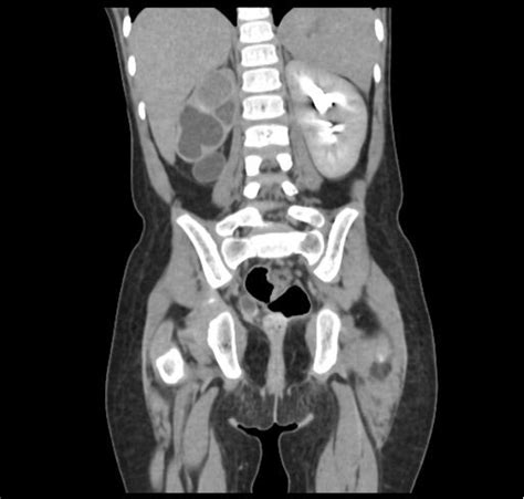 Figure 1 From Successful Management Of Single System Ectopic Ureter