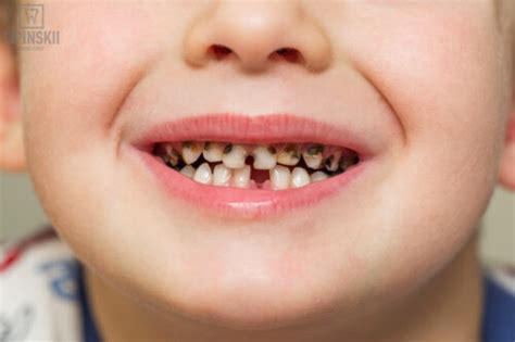 Dental Abscess In Children