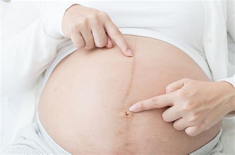 Mengenal Linea Nigra Garis Hitam Pada Perut Ibu Hamil