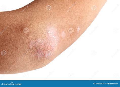 Psoriasis On Arm Stock Photo Image Of Problem Disorder 40723078