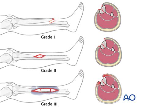 Principles of management of open fractures