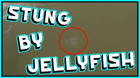 I Got Stung By A Jellyfish Youtube