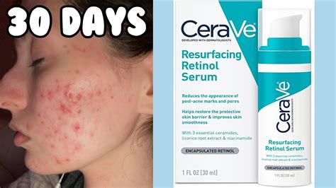 I Tried The Cerave Resurfacing Retinol Serum For My Acne 1 Month Test Youtube