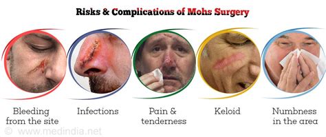 Mohs Surgery For Skin Cancer Advantages Risks And Complications