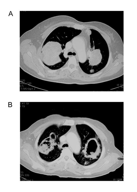 Computerized Tomography Scans Of The Metastatic Tumors At Baseline A