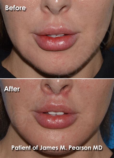 Lip Lift Photos Before After Dr James Pearson Facial Plastic Surgery
