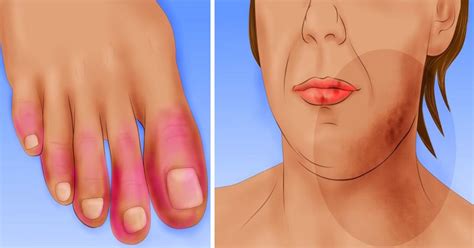 Early Warning Signs Of Lupus You Need To Know And What To Do The