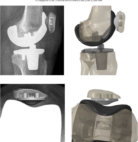 Figure 5 From A Patient Specific Model Of Total Knee Arthroplasty To