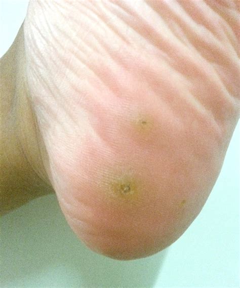 List Pictures Psoriasis On Bottom Of Feet Pictures Latest