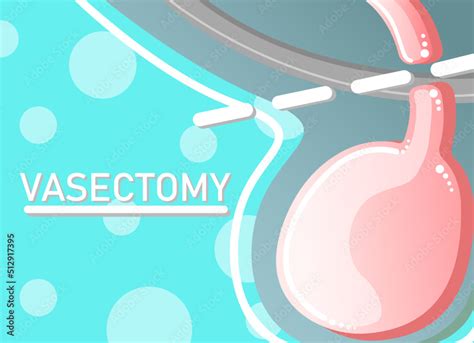 Cartoon Style Vasectomy Example Vector Illustration Stock Vector