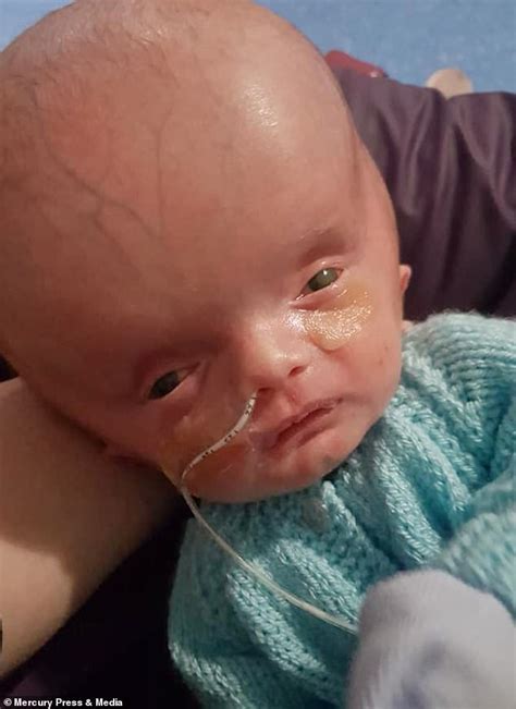 Baby Born With A Swollen Head Defies Doctors Who Told His Mother To Terminate Pregnancy Daily